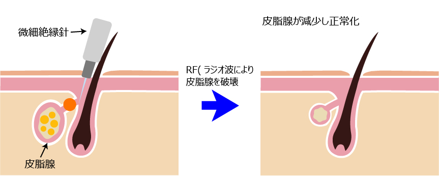 玉B퉻 