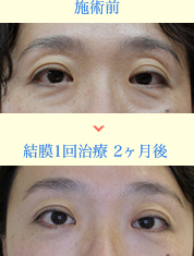 スマイルアイリフト施術前・結膜1回治療 2ヶ月後