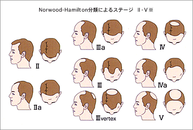 Norwood-HamiltonނɂXe[W@Ⅱ-X