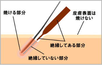 絶縁針医学電気脱毛